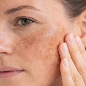 Darbs ar hiperpigmentāciju: kopšana, pīlingi un injekcijas 5TIP, LĀPPOS Nr. TIP2026/152